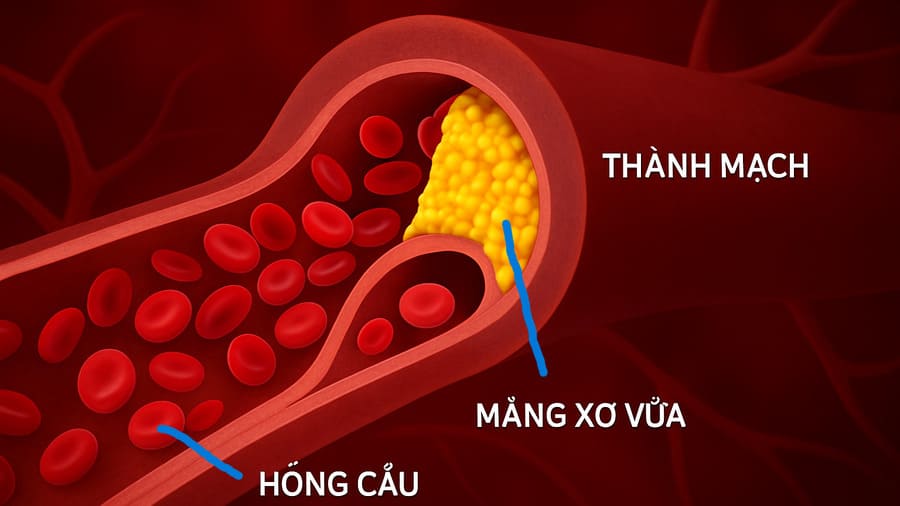Máu nhiễm mỡ có uống được mật ong không? 8 cách uống đúng 3 Bệnh máu nhiễm mỡ là bệnh gì